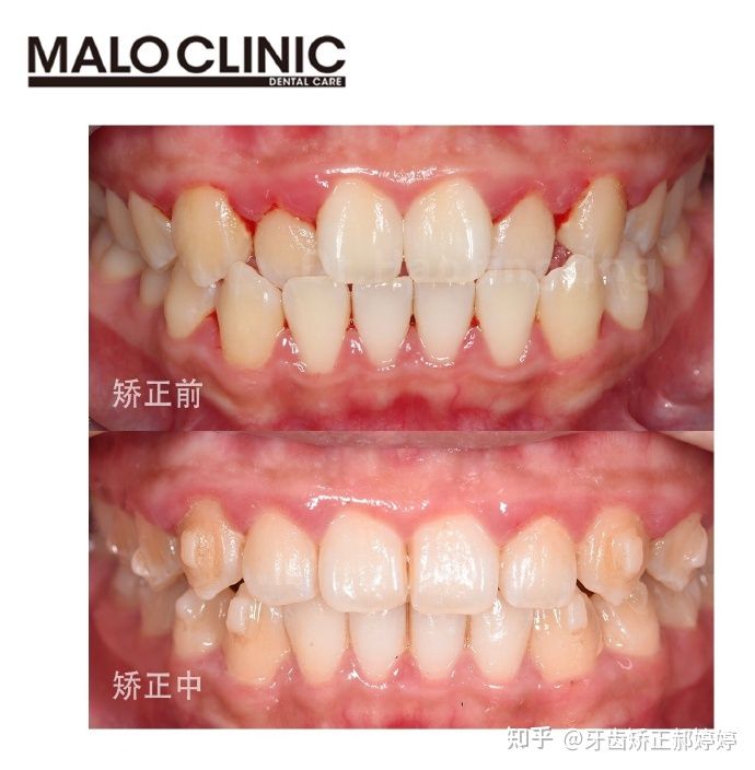 上海成人牙齿矫正失败案例,上海牙齿矫正郝婷婷医生