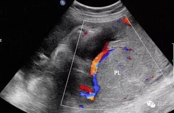 帆状胎盘变普通胎盘,帆状胎盘是由啥原因导致的
