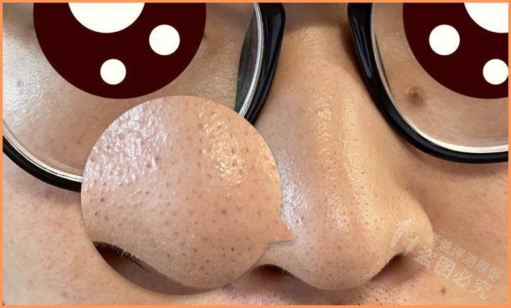 毛孔粗大问题应该如何正确解决,毛孔粗大怎么办教你一招根除