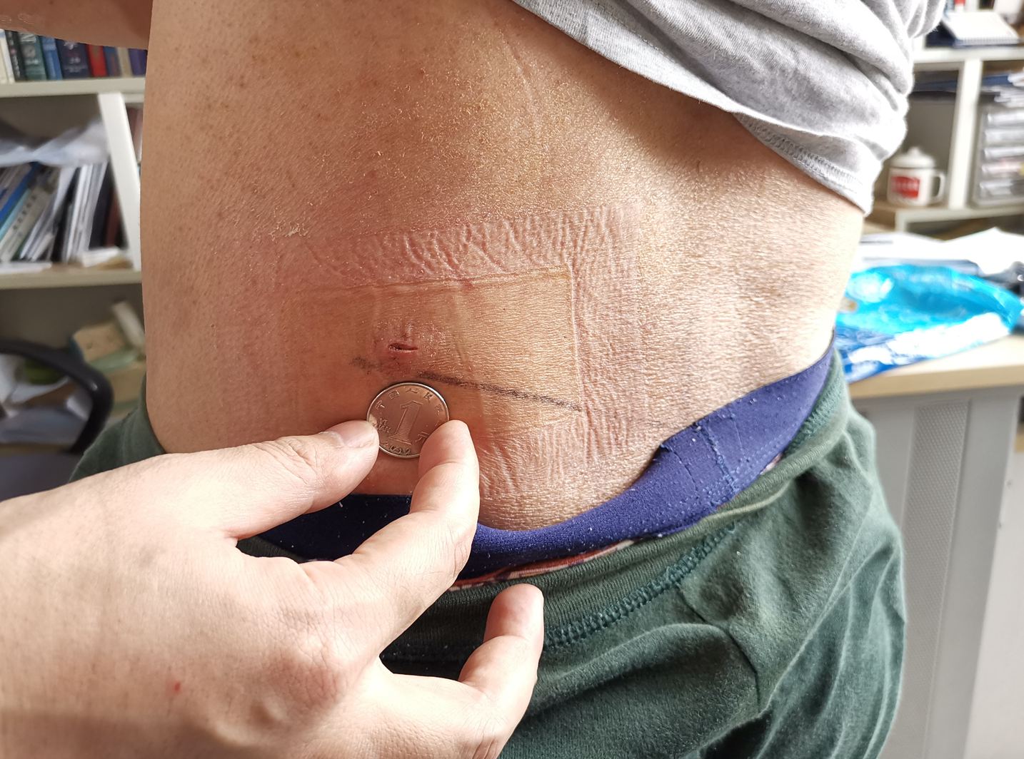 腰突微创术后怎样进行康复锻炼,腰突微创手术一个月后如何锻炼