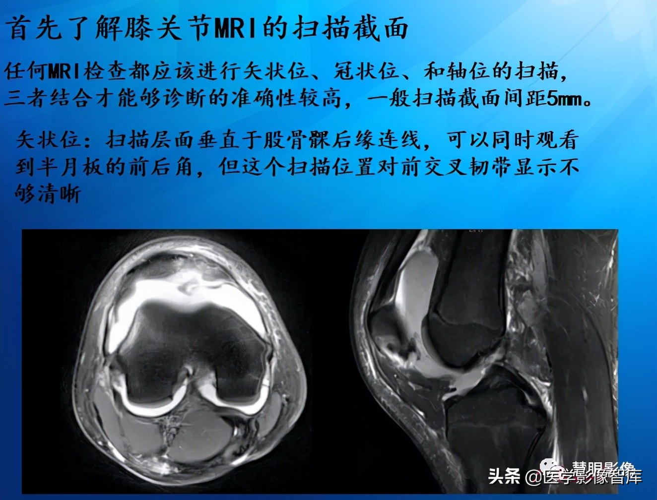 膝关节半月板损伤的解剖结构图,半月板mri解剖图解