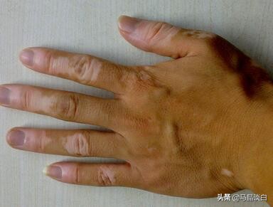 脚冻疮对白癜风有影响吗,白癜风冻疮