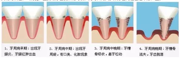 疫情防控期间如何正确预防及应对口腔问题