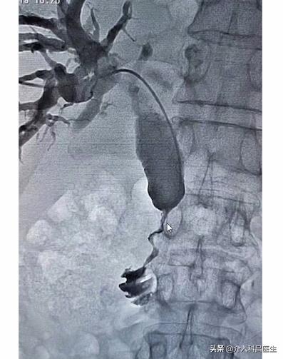 病人眼睛变成黄色是什么原因,病人眼珠白色部位变黄