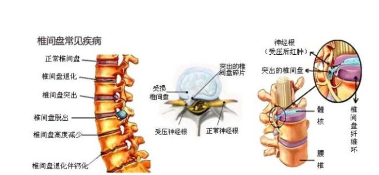 肾虚引发的腰疼是哪种,肾虚腰疼治疗法
