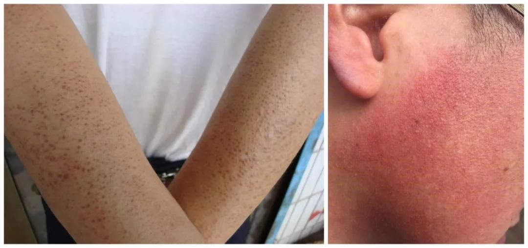 如何消除鸡皮肤学生党,告别蛇皮肌肤