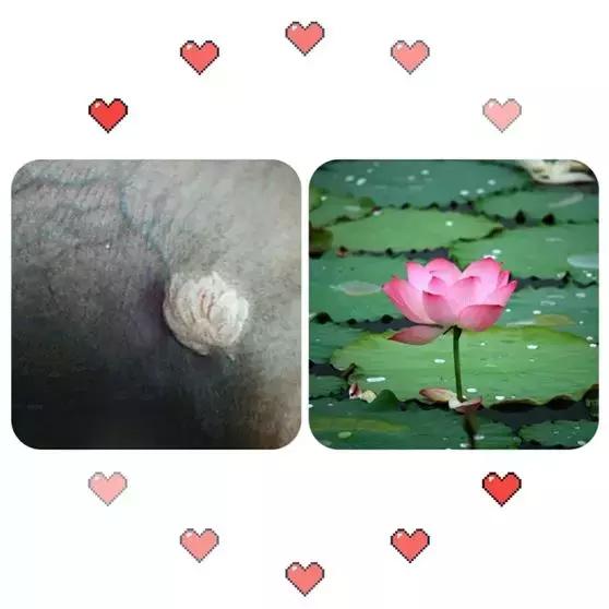 食管壁上美丽的“莲花”在无痛胃肠镜下现出了魔影