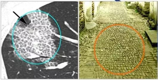肺部ct十大征象,肺部ct正常图和异常图的区别