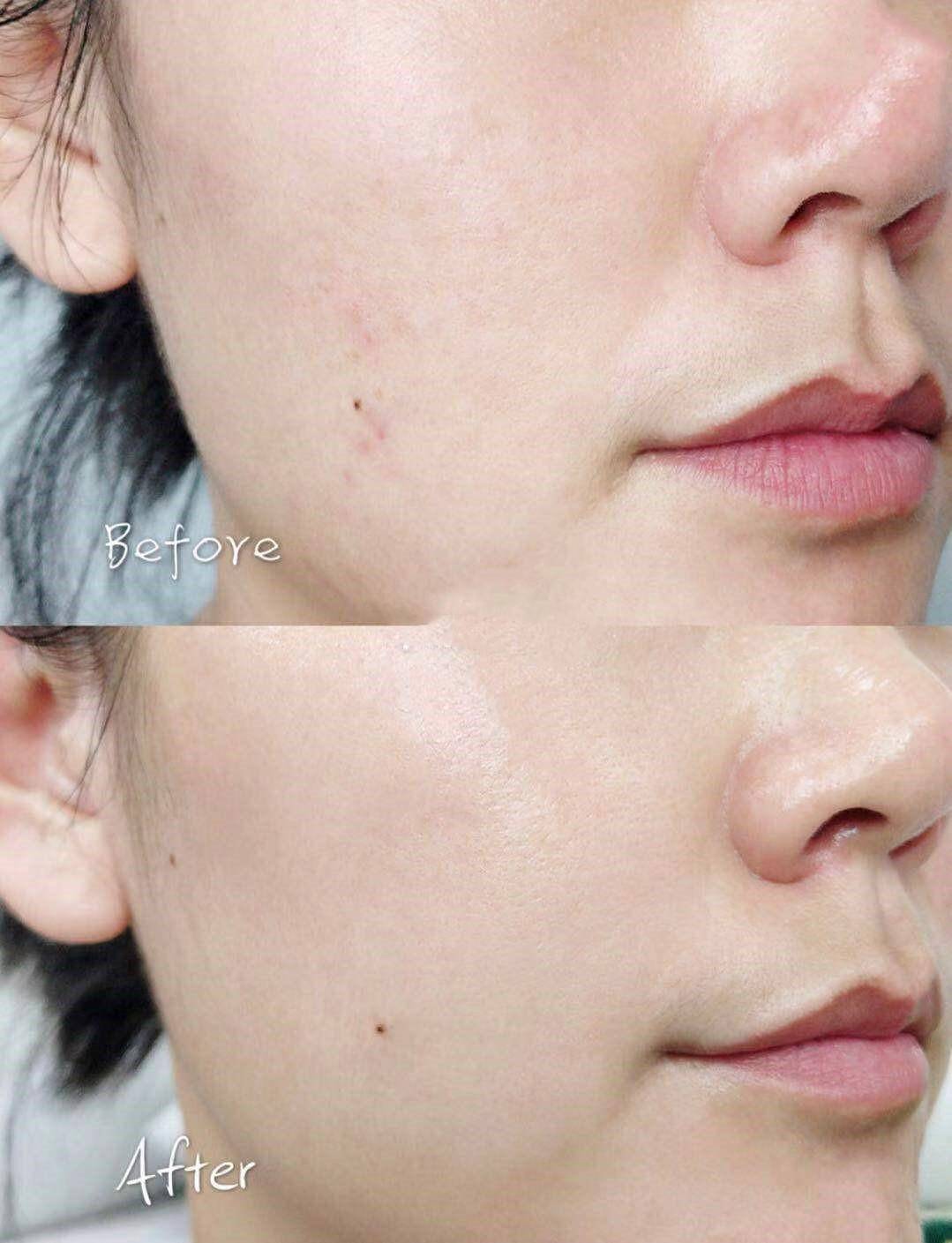 刷酸到底好不好,美容刷酸的副作用是什么