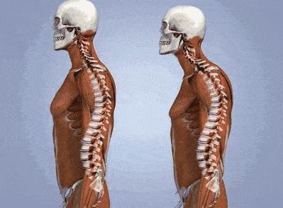 “翘臀”还有假?先自测再确认:你是真“翘臀”还是骨盆前倾?