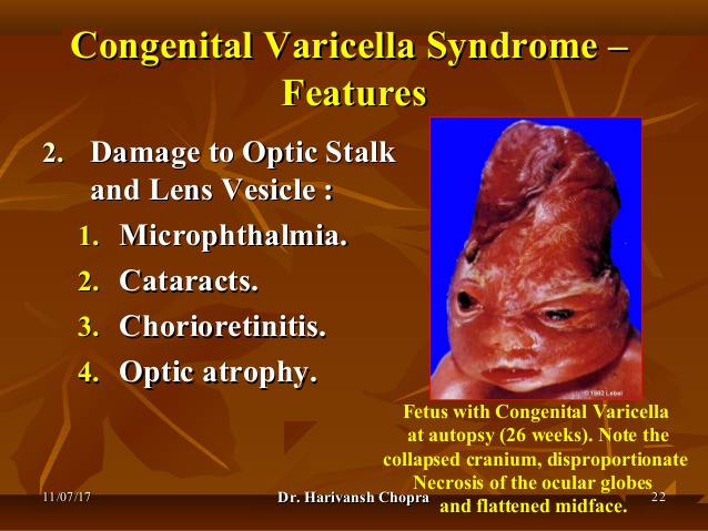 疫苗相关问答,水痘疫苗流程