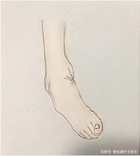 脑梗脑出血后患者足内翻该如何康复锻炼？被动+主动手法，很详细