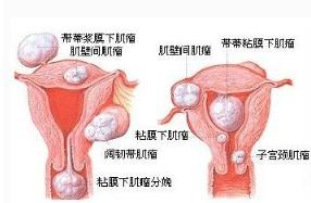 桂枝茯苓丸治疗子宫肌瘤,桂枝茯苓丸治疗子宫肌瘤原理