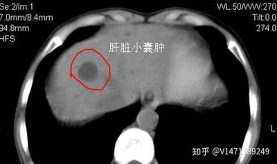肝囊肿长水泡是什么原因,80岁老人肝囊肿肺水泡