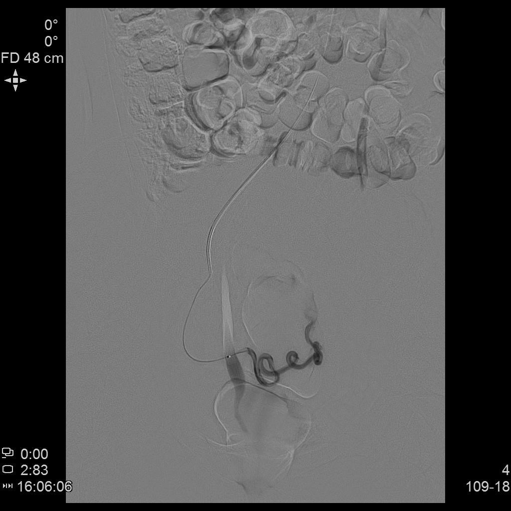 子宫肌瘤介入栓塞造影剂作用,子宫肌瘤介入栓塞有副作用吗