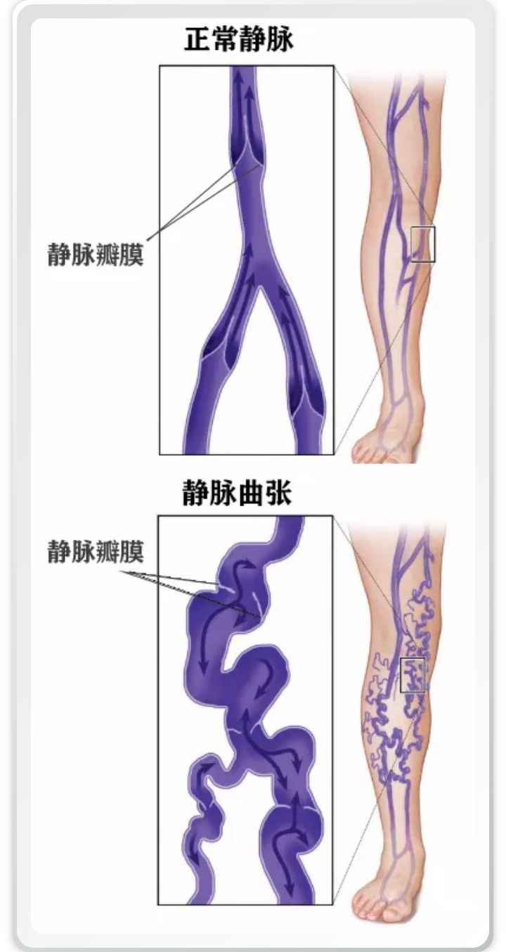 预防静脉曲张的关键就是了解病因,精索静脉曲张的原因