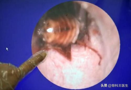 医院取出的异物怎么处理,医生都从患者体内取出过什么异物