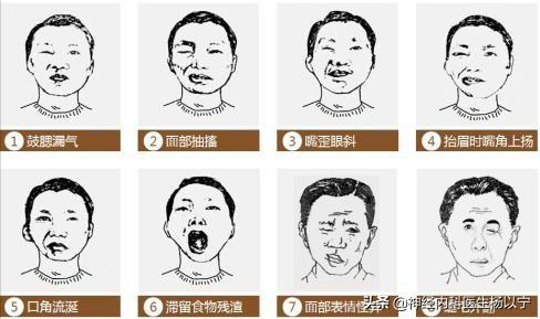 皱眉右脸没有皱纹是面瘫了吗,两侧嘴角下垂面瘫图