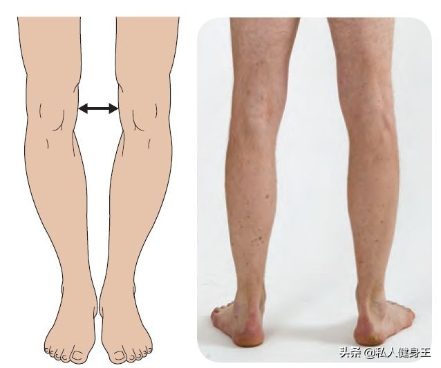o型腿的原因与防治,o型腿的成因和危害