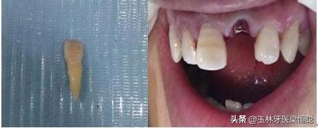 牙齿磕掉了怎么办大班安全教案,牙齿磕掉了怎么办幼儿动画