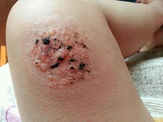 艾灸感到热和疼,艾灸时感觉很舒服