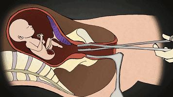 19岁流产对身体伤害有多大,年满18流产需要多少费用