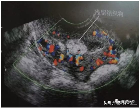 妇科常见疾病的超声诊断视频,超声常见疾病