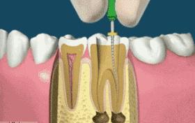 牙齿松动怎么办还能矫正吗,五十左右牙齿松动掉落说明啥