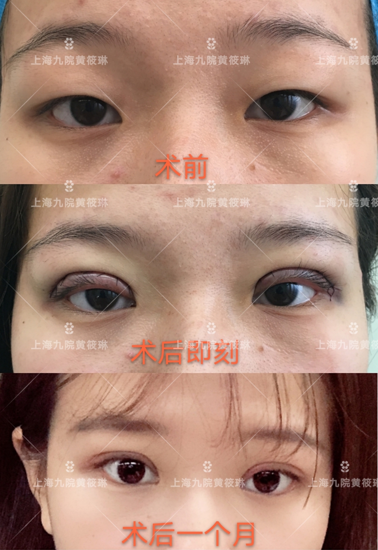 双眼皮消肿以后还是变宽,双眼皮吃什么药消肿比较快