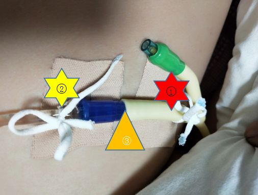 尿管固定别小看5cm，却是“血”的差距