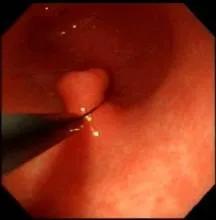 胃息肉癌变怎么治疗,胃息肉一定会癌变吗