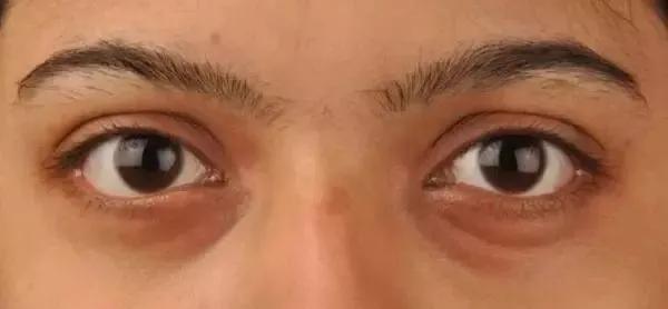 黑眼圈是不是熬夜熬的,有黑眼圈真是因为熬夜吗