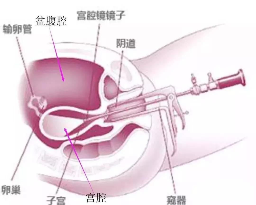 子宫息肉不孕,不孕的头号杀手