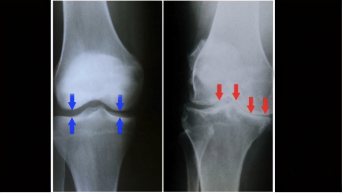 关节疼吃盐酸氨基葡萄糖管用吗,关节痛吃葡萄糖酸钙管用吗