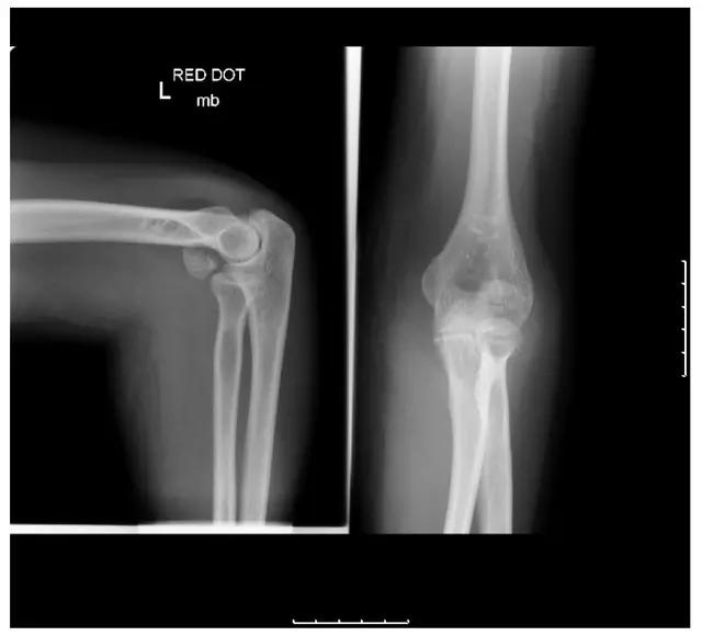 几种严重骨折医学名称,常见的骨折有哪些名称