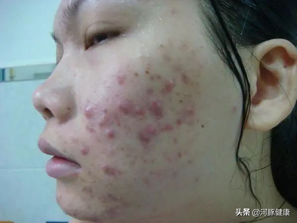 被痘痘毁掉的脸,治毒疮最好的中成药