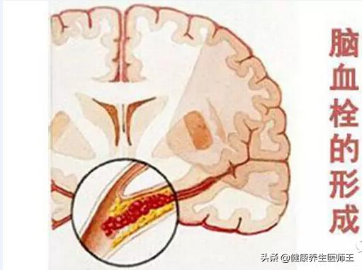 生命健康有哪些方面,临床症状脑血栓形成