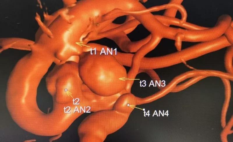山东大学齐鲁医院王东海教授团队成功治疗多发性动脉瘤