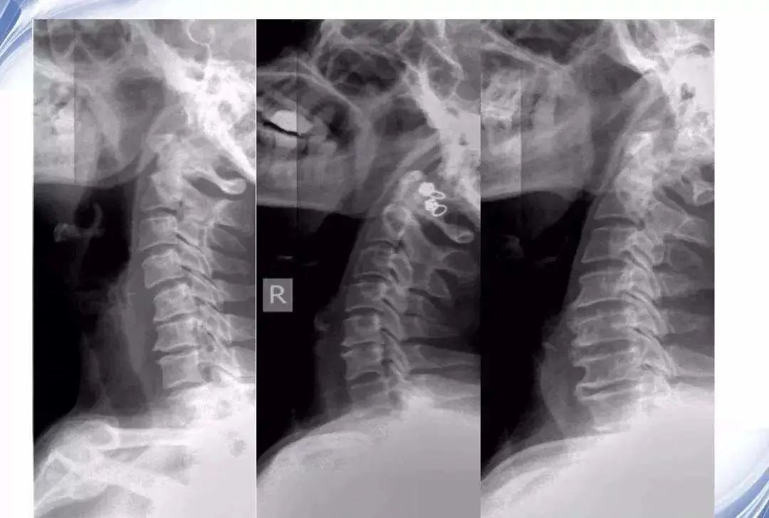 长假期玩手机不适严重到要手术？——新冠肺炎疫情下的假性颈椎病