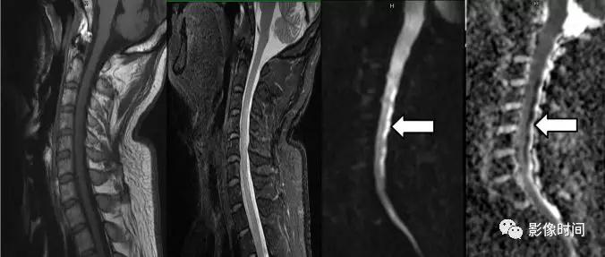 脊髓病变案例图文问诊,脊髓病变视频