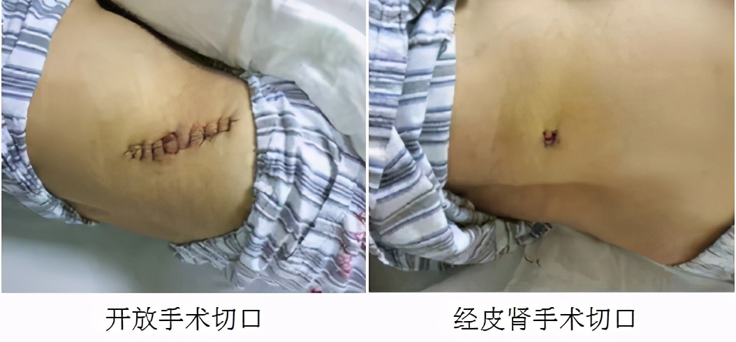 经皮肾镜碎石手术取出的结石,经皮肾镜碎石取石术的病历