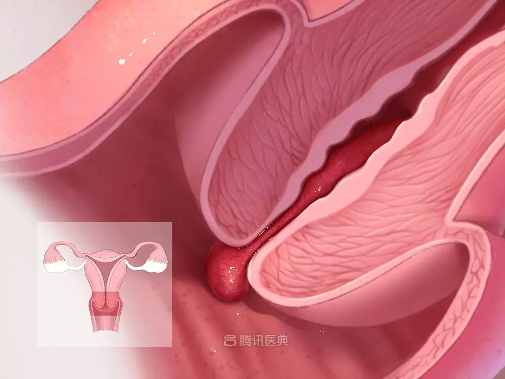 癌变的肉有哪些,身上长的肉赘会癌变吗