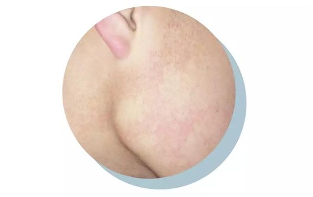 闭口顽固不消学会这招秒变鸡蛋肌,顽固痘痘痘印闭口怎么消除小妙招