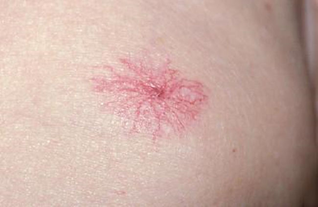 身上出现小红点一定要注意,身上出现小红点是什么原因引起的