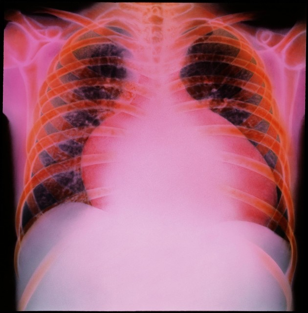 家人犯了心脏病怎么处理,家人心衰三级怎么面对