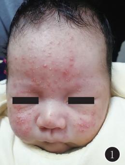 新生儿长脓疱疮需要治疗吗,新生儿宝宝常见的痘痘有哪些