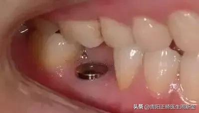 牙齿以前齐现在不齐是什么原因,牙齿排列整齐牙缝大前门牙凸