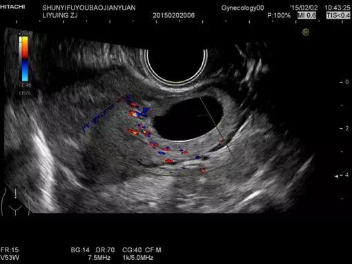 阴式超声怎么做,腹式超声和阴式超声