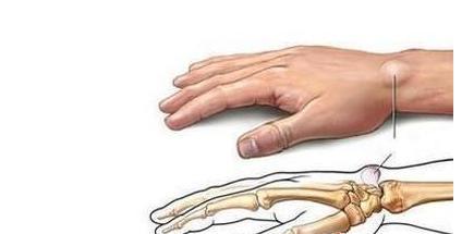 腕部腱鞘囊肿怎么治疗,奶奶抱孩子累得腱鞘炎怎么办