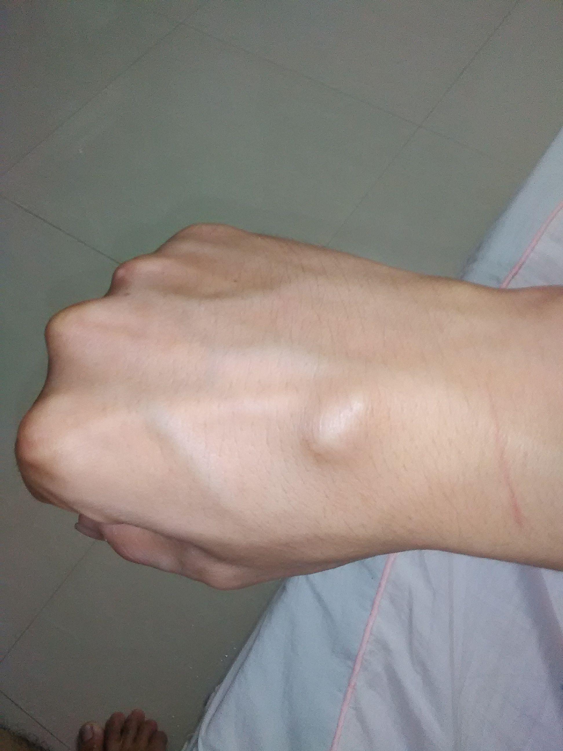 手腕腱鞘囊肿没肿但是痛怎么处理,手腕突然鼓起硬包摸起来不痛